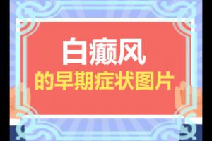 [是否正规]长白斑是什么引起的-天性白斑是怎么原因造成的