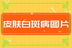 特定电磁波治疗器治疗白癫疯？会怎么样